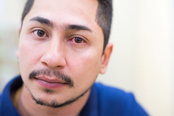 Man With a Red Irritated Eye